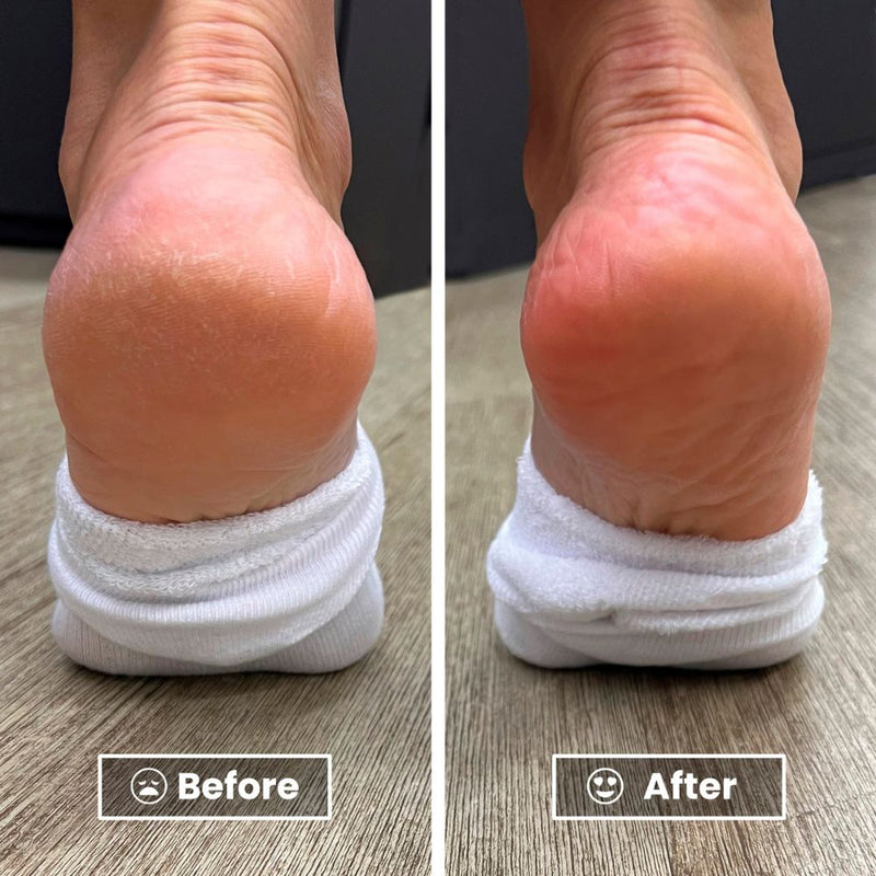 The before and after image shows a foot with dry, cracked heels on the left and the same heel noticeably smoother and less dry on the right, thanks to LONDONTOWN's nourishing Foot Balm.