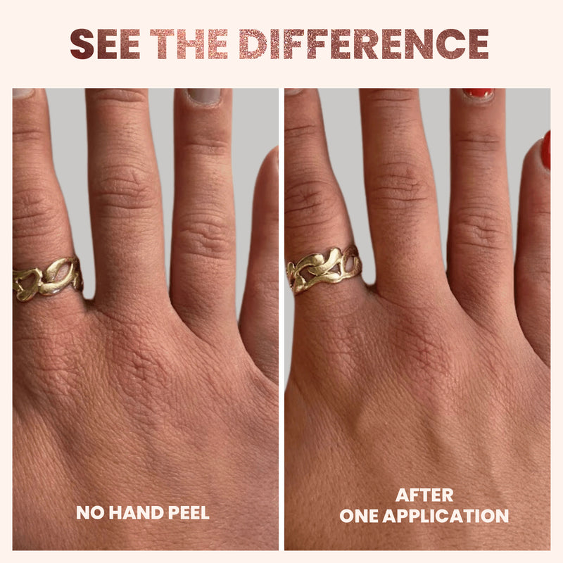 Comparison of a hand before and after using the Rose Gold Hand Peel by LONDONTOWN. Left: dry skin, no treatment. Right: visibly smoother hands after just one application of the hand mask. Gold ring on the ring finger in both images.