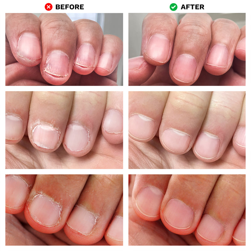 Before and after images of fingernails showing improvement with No Bite Nail Recovery by LONDONTOWN. The “before” images depict brittle, damaged nails. The “after” images show healthy-looking nails, illustrating how using No Bite Nail Recovery can lead to smoother, healthier nails.