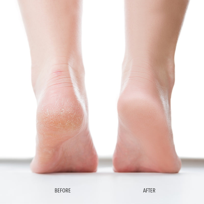 Image showing a comparison of feet: the left foot labeled "Before" has dry, cracked skin, while the right foot labeled "After" shows smooth, moisturized skin after using LONDONTOWN's Foot Scrub with natural sugar crystals.